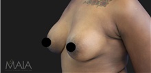 Breast Augmentation After Photo by Munique Maia, MD; Tysons Corner, VA - Case 48967