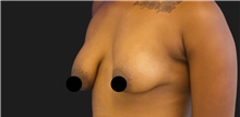 Breast Augmentation Before Photo by Munique Maia, MD; Tysons Corner, VA - Case 48967