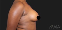 Breast Augmentation After Photo by Munique Maia, MD; Tysons Corner, VA - Case 48967