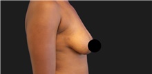 Breast Augmentation Before Photo by Munique Maia, MD; Tysons Corner, VA - Case 48967