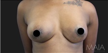 Breast Augmentation After Photo by Munique Maia, MD; Tysons Corner, VA - Case 48967