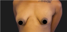 Breast Augmentation Before Photo by Munique Maia, MD; Tysons Corner, VA - Case 48967