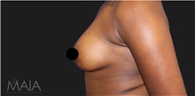 Breast Augmentation After Photo by Munique Maia, MD; Tysons Corner, VA - Case 48967