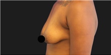 Breast Augmentation Before Photo by Munique Maia, MD; Tysons Corner, VA - Case 48967