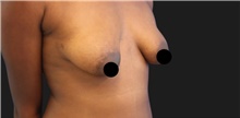 Breast Augmentation Before Photo by Munique Maia, MD; Tysons Corner, VA - Case 48967