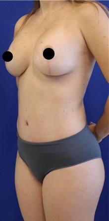 Breast Augmentation After Photo by Munique Maia, MD; Tysons Corner, VA - Case 48968