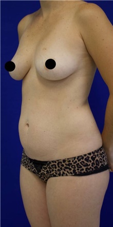 Breast Augmentation Before Photo by Munique Maia, MD; Tysons Corner, VA - Case 48968