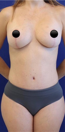 Breast Augmentation After Photo by Munique Maia, MD; Tysons Corner, VA - Case 48968