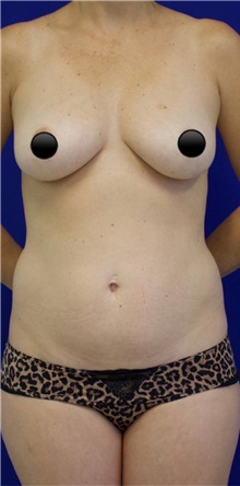 Breast Augmentation Before Photo by Munique Maia, MD; Tysons Corner, VA - Case 48968