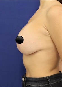 Breast Augmentation After Photo by Munique Maia, MD; Tysons Corner, VA - Case 48969