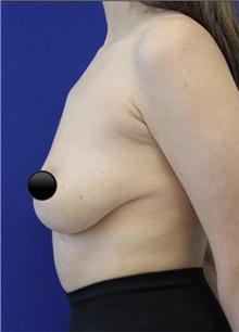 Breast Augmentation Before Photo by Munique Maia, MD; Tysons Corner, VA - Case 48969