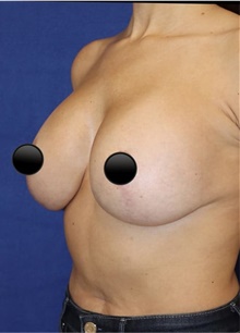 Breast Augmentation After Photo by Munique Maia, MD; Tysons Corner, VA - Case 48969