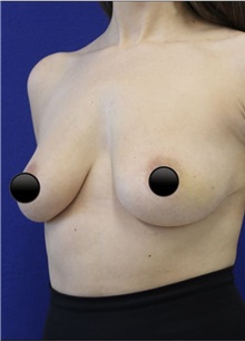 Breast Augmentation Before Photo by Munique Maia, MD; Tysons Corner, VA - Case 48969