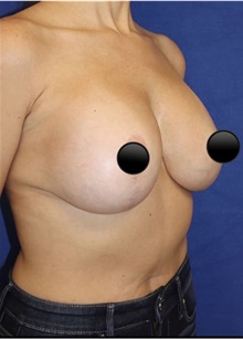 Breast Augmentation After Photo by Munique Maia, MD; Tysons Corner, VA - Case 48969