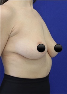 Breast Augmentation Before Photo by Munique Maia, MD; Tysons Corner, VA - Case 48969