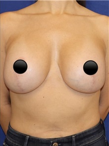 Breast Augmentation After Photo by Munique Maia, MD; Tysons Corner, VA - Case 48969