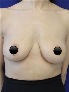 Breast Augmentation Before Photo by Munique Maia, MD; Tysons Corner, VA - Case 48969