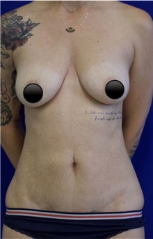 Breast Augmentation Before Photo by Munique Maia, MD; Tysons Corner, VA - Case 48970