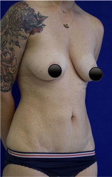 Breast Augmentation Before Photo by Munique Maia, MD; Tysons Corner, VA - Case 48970