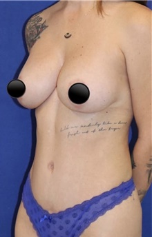 Breast Augmentation After Photo by Munique Maia, MD; Tysons Corner, VA - Case 48970