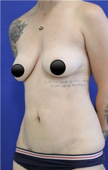 Breast Augmentation Before Photo by Munique Maia, MD; Tysons Corner, VA - Case 48970