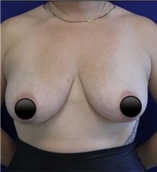 Breast Augmentation Before Photo by Munique Maia, MD; Tysons Corner, VA - Case 48971