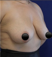 Breast Augmentation Before Photo by Munique Maia, MD; Tysons Corner, VA - Case 48971