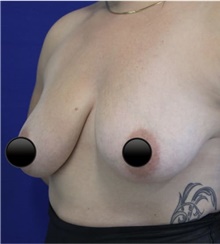 Breast Augmentation Before Photo by Munique Maia, MD; Tysons Corner, VA - Case 48971