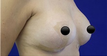 Breast Augmentation After Photo by Munique Maia, MD; Tysons Corner, VA - Case 48972