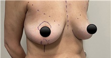 Breast Augmentation Before Photo by Munique Maia, MD; Tysons Corner, VA - Case 48972