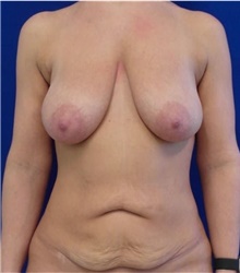 Breast Augmentation Before Photo by Munique Maia, MD; Tysons Corner, VA - Case 48973