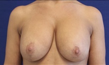 Breast Augmentation After Photo by Munique Maia, MD; Tysons Corner, VA - Case 48973