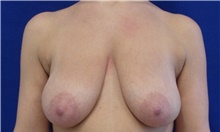 Breast Augmentation Before Photo by Munique Maia, MD; Tysons Corner, VA - Case 48973