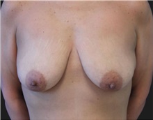 Breast Lift Before Photo by Munique Maia, MD; Tysons Corner, VA - Case 48974
