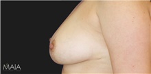 Breast Reduction After Photo by Munique Maia, MD; Tysons Corner, VA - Case 48975