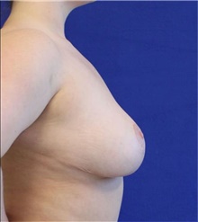 Breast Reduction After Photo by Munique Maia, MD; Tysons Corner, VA - Case 48976