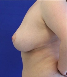 Breast Reduction After Photo by Munique Maia, MD; Tysons Corner, VA - Case 48976