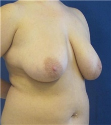 Breast Reduction Before Photo by Munique Maia, MD; Tysons Corner, VA - Case 48976