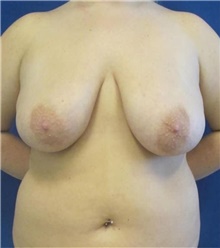 Breast Reduction Before Photo by Munique Maia, MD; Tysons Corner, VA - Case 48976