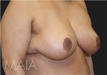 Breast Reduction After Photo by Munique Maia, MD; Tysons Corner, VA - Case 48978