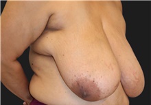 Breast Reduction Before Photo by Munique Maia, MD; Tysons Corner, VA - Case 48978
