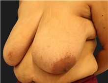 Breast Reduction Before Photo by Munique Maia, MD; Tysons Corner, VA - Case 48978