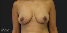 Breast Reduction After Photo by Munique Maia, MD; Tysons Corner, VA - Case 48979