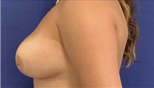 Breast Reduction After Photo by Munique Maia, MD; Tysons Corner, VA - Case 48982
