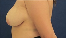 Breast Reduction Before Photo by Munique Maia, MD; Tysons Corner, VA - Case 48982