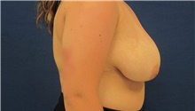 Breast Reduction Before Photo by Munique Maia, MD; Tysons Corner, VA - Case 48982