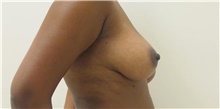 Breast Reduction Before Photo by Munique Maia, MD; Tysons Corner, VA - Case 48985