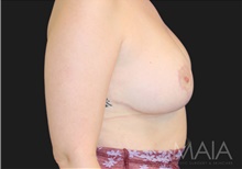 Breast Reduction After Photo by Munique Maia, MD; Tysons Corner, VA - Case 48986