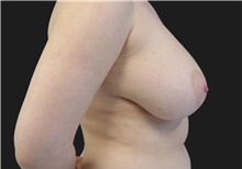 Breast Reduction Before Photo by Munique Maia, MD; Tysons Corner, VA - Case 48986