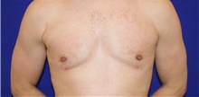 Male Breast Reduction After Photo by Munique Maia, MD; Tysons Corner, VA - Case 48992